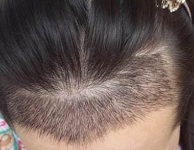 女人植发有什么好处 植发能维持多久