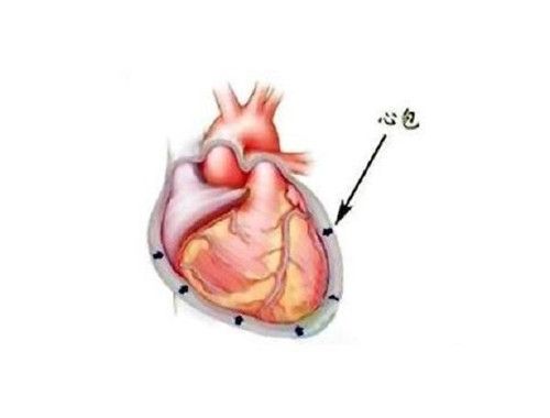 ​少量心包积液会自愈吗 心包积液有哪些症状