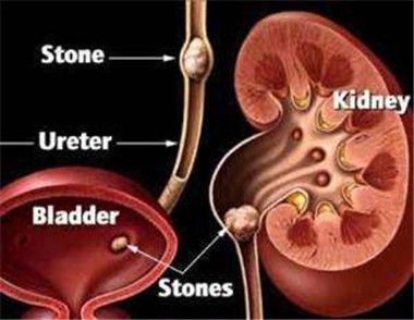 腎結石有哪些症狀 哪些方法可以預防腎結石