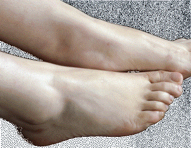 汗腳是什麼原因 汗腳怎麼治療