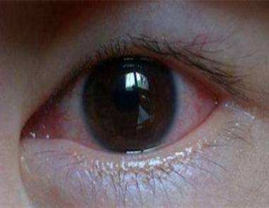 眼睛充血是怎麼回事 眼睛充血怎麼消除