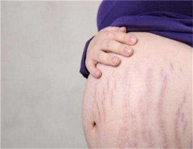 产后怎么去除妊娠纹 3个简单的祛除妊娠纹方法