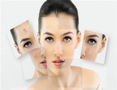 敏感肌膚如何避免成為激素臉 敏感肌膚飲食注意事項