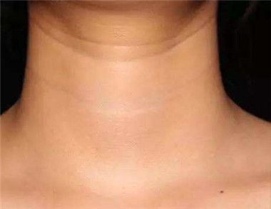 脖子有颈纹怎么消除 4个妙招就可以消除