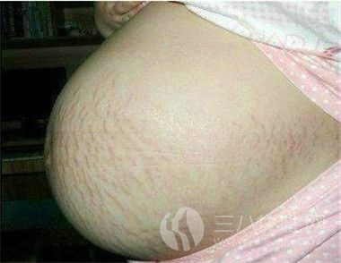 妊娠纹产后怎么修复 有什么小秘方.jpg