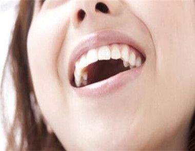 如何預防牙齒黃 美白牙膏有用嗎