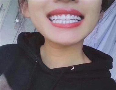牙齒黃怎麼變白 要注意什麼