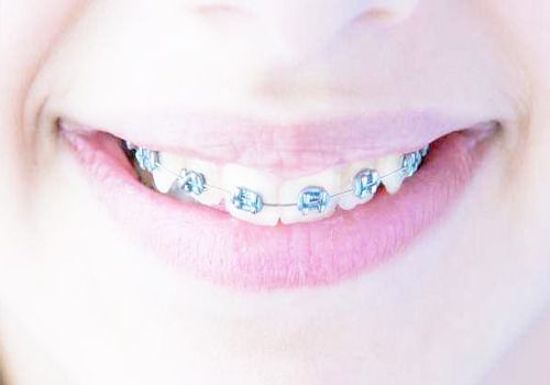牙齿矫正的好处 做牙齿整形手术的注意事项