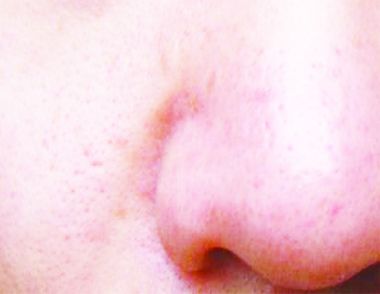 女性冬天鼻子红怎么办 缓解鼻子变红的方法