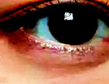 黑眼圈是什麼原因？5種原因導致黑眼圈嚴重
