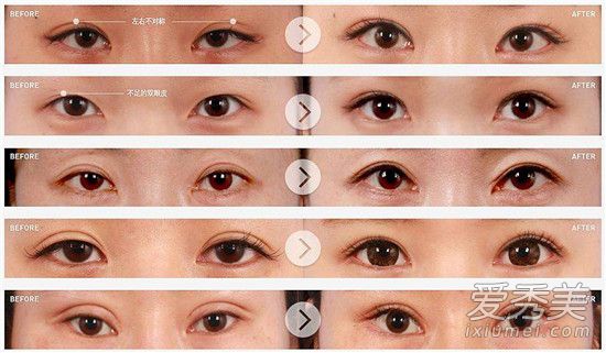 雙眼皮修複怎麼做的 雙眼皮修複寬修窄原理