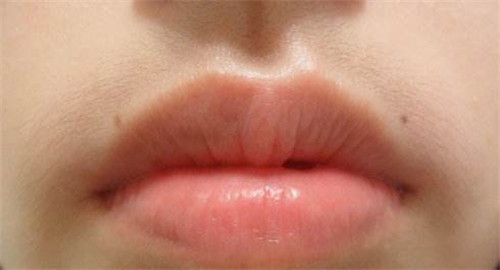 女孩子唇毛多是什麼原因 怎麼樣去除唇毛