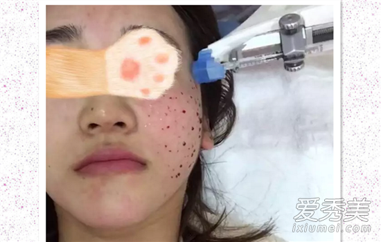 打水光针后多久可以化妆 打水光针后多久可以用护肤品