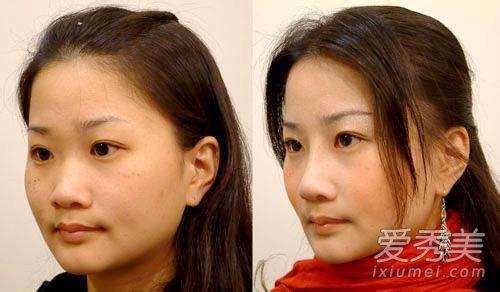 假体隆鼻多少费用 假体隆鼻多久完全消肿