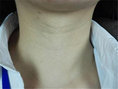 颈纹是怎么形成的 怎么去除颈纹