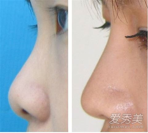 耳软骨隆鼻能保持多久 耳软骨隆鼻是永久吗