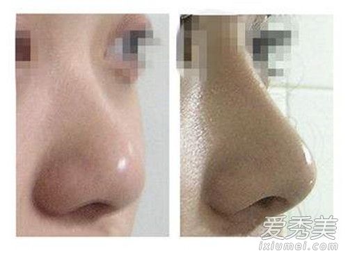 假体隆鼻多少费用 假体隆鼻多久完全消肿