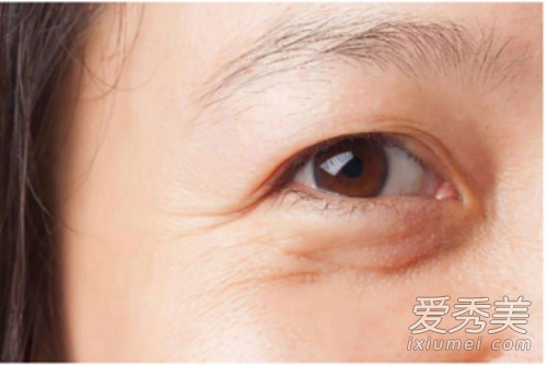 眼袋大是什么原因造成的 促进眼袋形成的5类特征