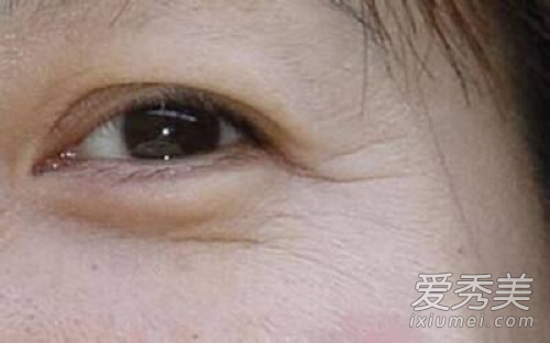 眼部祛皱纹有什么方法 小偏方除皱纹抵抗皮肤衰老