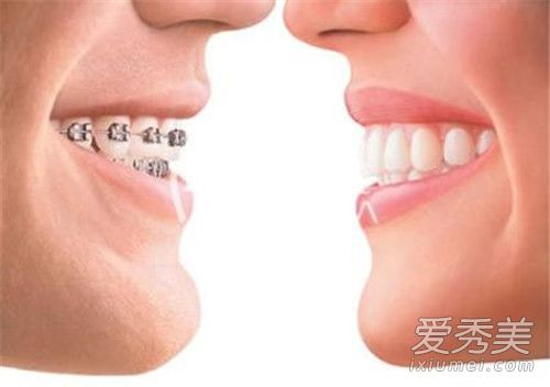 牙齿矫正的最佳年龄 牙齿矫正多少钱