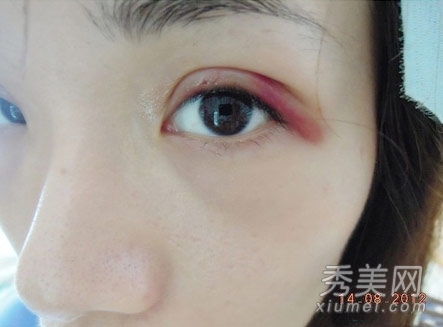 医学美容：美女自曝双眼皮手术过程图