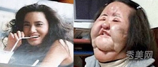 明星爱美整容失败 轻者毁容重者丧命