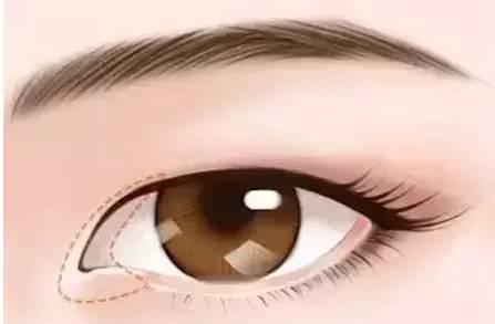 整形小常識：7大眼部手術你了解多少？ 眼部整形手術