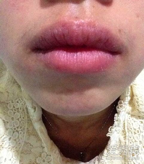 春季嘴唇起皮紅腫 不可盲目塗潤唇膏 過敏性唇炎