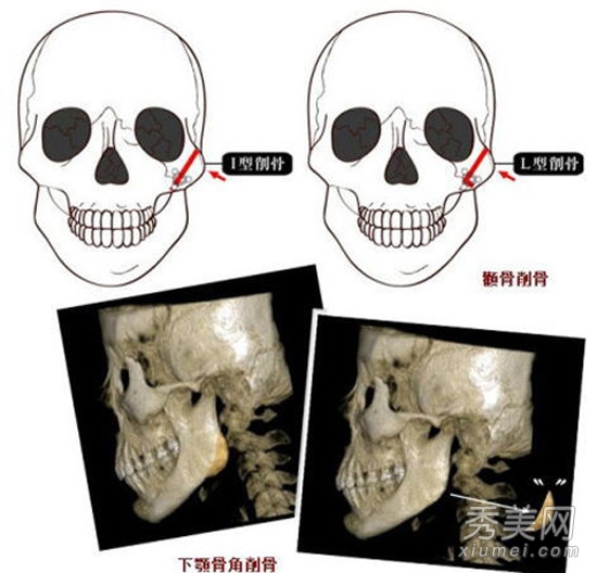 26岁台湾“削骨美女” 整形削骨全过程