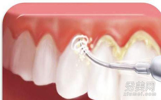 洗牙误区：牙齿越白越好？洗牙伤牙齿？