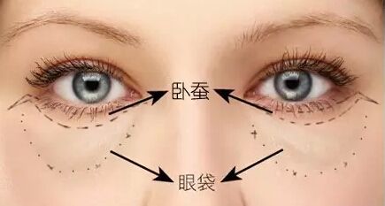 眼袋和卧蚕的区别 如何正确区分眼袋和卧蚕