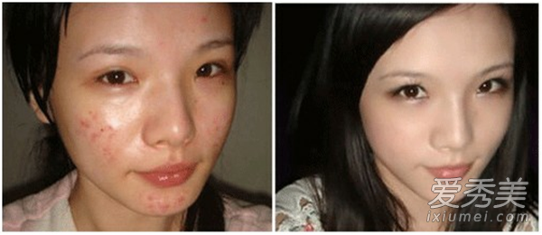 臉上痤瘡的治療方法 4招修複痤瘡疤痕 痤瘡怎麼治療