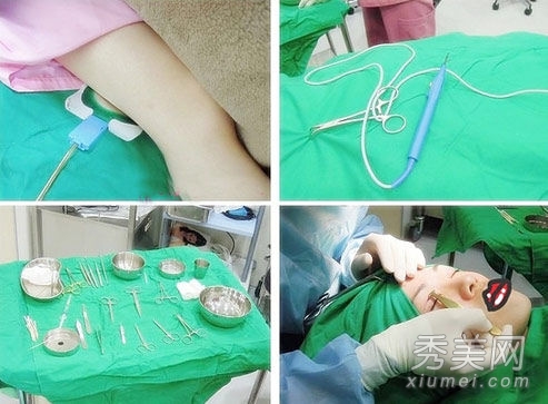 醫學美容：美女自曝雙眼皮手術過程圖