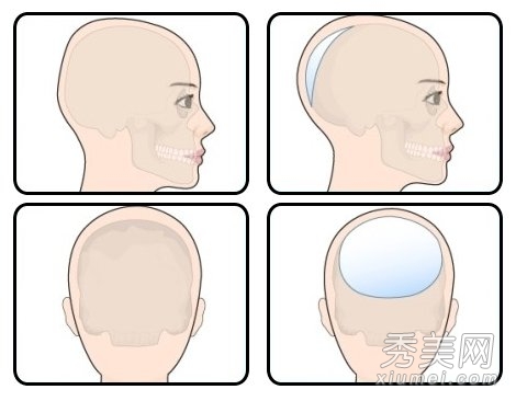 另类整容：韩国流行后脑勺整形术