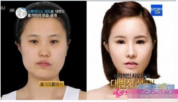 图揭韩国人造美女 丑女变美整容前后