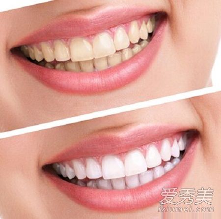 牙齿美白贴有用吗 美白牙贴对牙齿有伤害吗