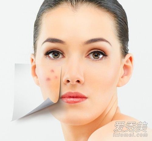 怎么快速消除痘痘粉刺 5个方法学起来 如何去除粉刺痘痘