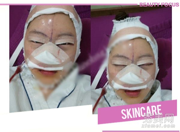 网友赴韩国整形 额头+双眼皮+隆鼻手术全过程