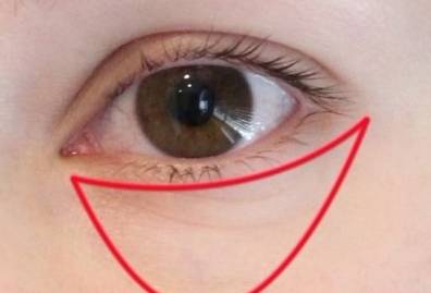 眼袋大是什么原因 眼袋怎么消除简单方法