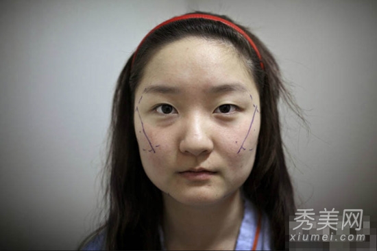 5位韩国整形模特 血腥整容手术高清图