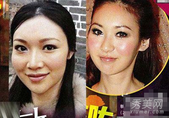 赵薇老公前女友 1年64针瘦脸针变僵尸脸