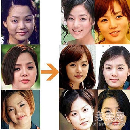 韩国女星整容后遗症 童颜少女变少妇