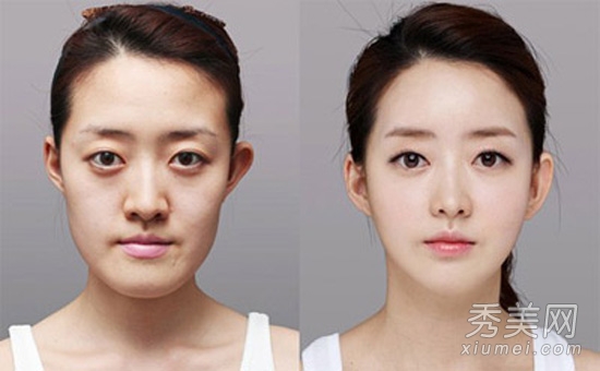 網友自曝赴韓國 整形塑臉全過程（圖）
