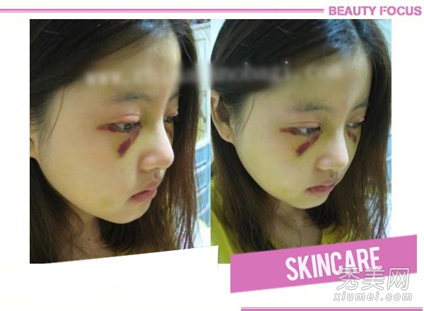 网友赴韩国整形 额头+双眼皮+隆鼻手术全过程