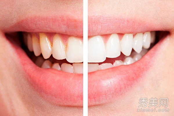 牙齒黃怎麼辦？ 教你5個美白牙齒方法