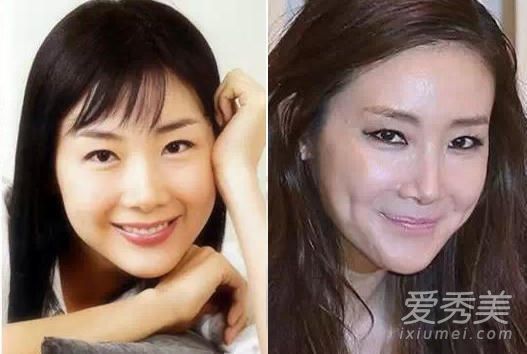 鼻子一捏就塌！女星告诉你整容后遗症多可怕