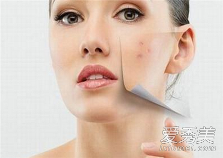 为什么脸上老长痘痘 疾病写在脸上