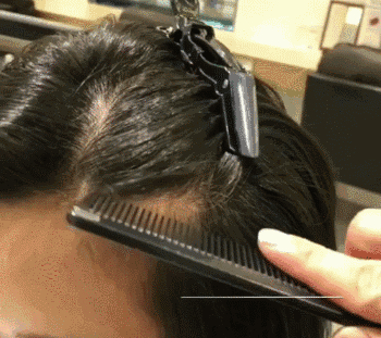 脱发发际线越来越高怎么办 脱发发际线高还可以恢复吗