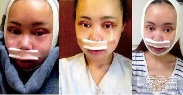 吴玉青花百万整成angelababy，可baby也是整的啊！ 整成baby的女孩图片