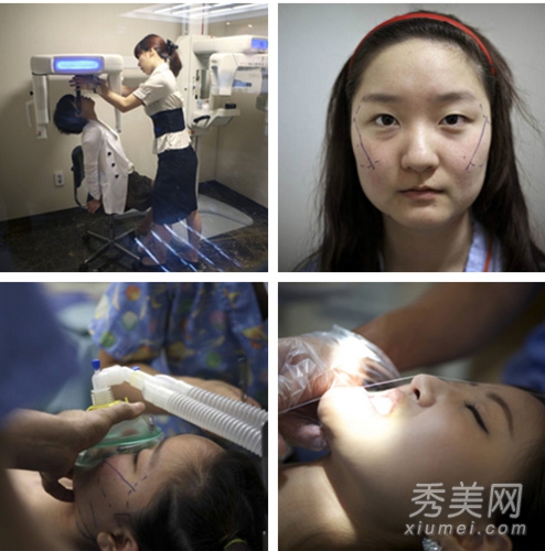 图揭韩国模特整容 手术过程太心酸
